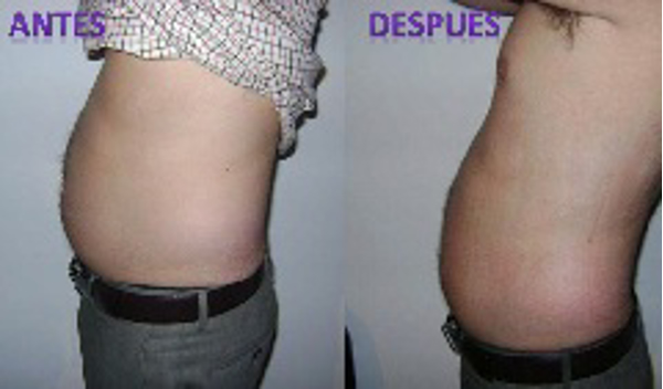 La franquicia Depelle te ayuda a esculpir tu cuerpo